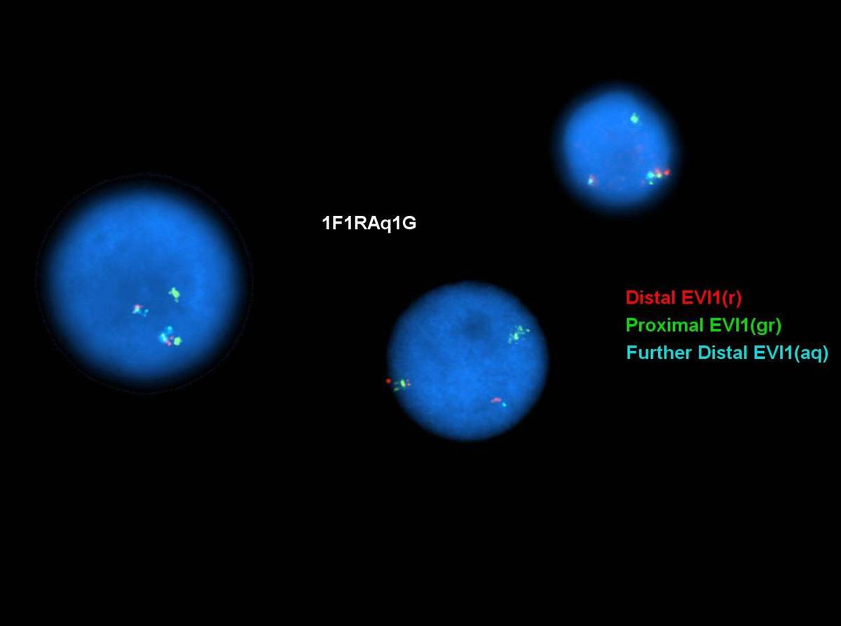 EV1-IGH rearrangement by FISH